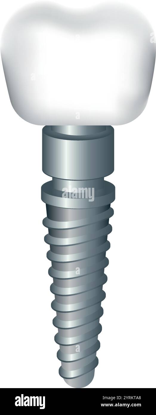 Illustration vectorielle d'un implant dentaire isolé sur fond transparent. Illustration de Vecteur