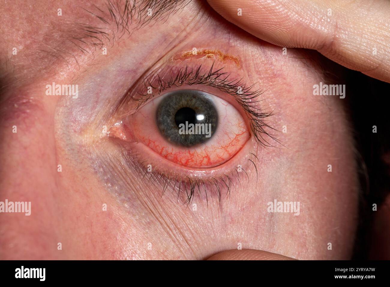 Gros plan d'yeux rouges irrités avec vaisseaux sanguins visibles et croûtes sur la paupière, indiquant une blépharite ou une autre infection oculaire Banque D'Images