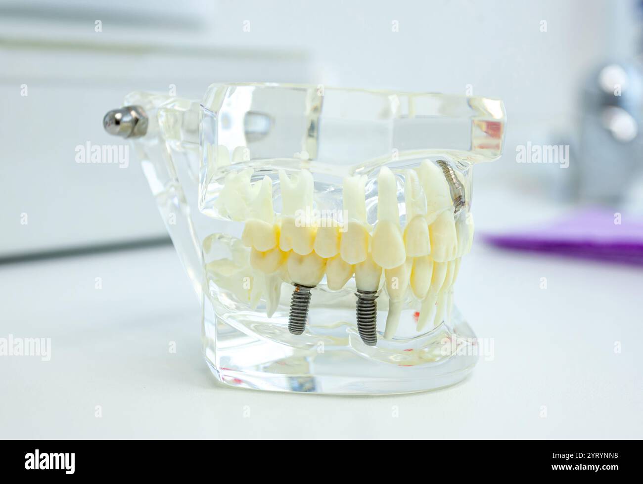 Modèle anatomique transparent de mâchoire humaine avec implants dentaires à l'intérieur d'une clinique dentaire Banque D'Images