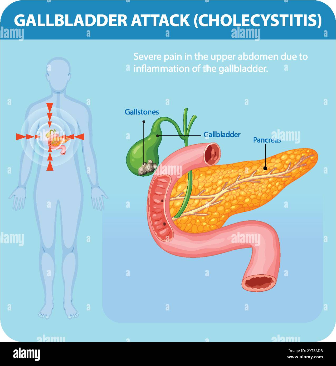 Illustration de l'inflammation de la vésicule biliaire et de la douleur associée Illustration de Vecteur