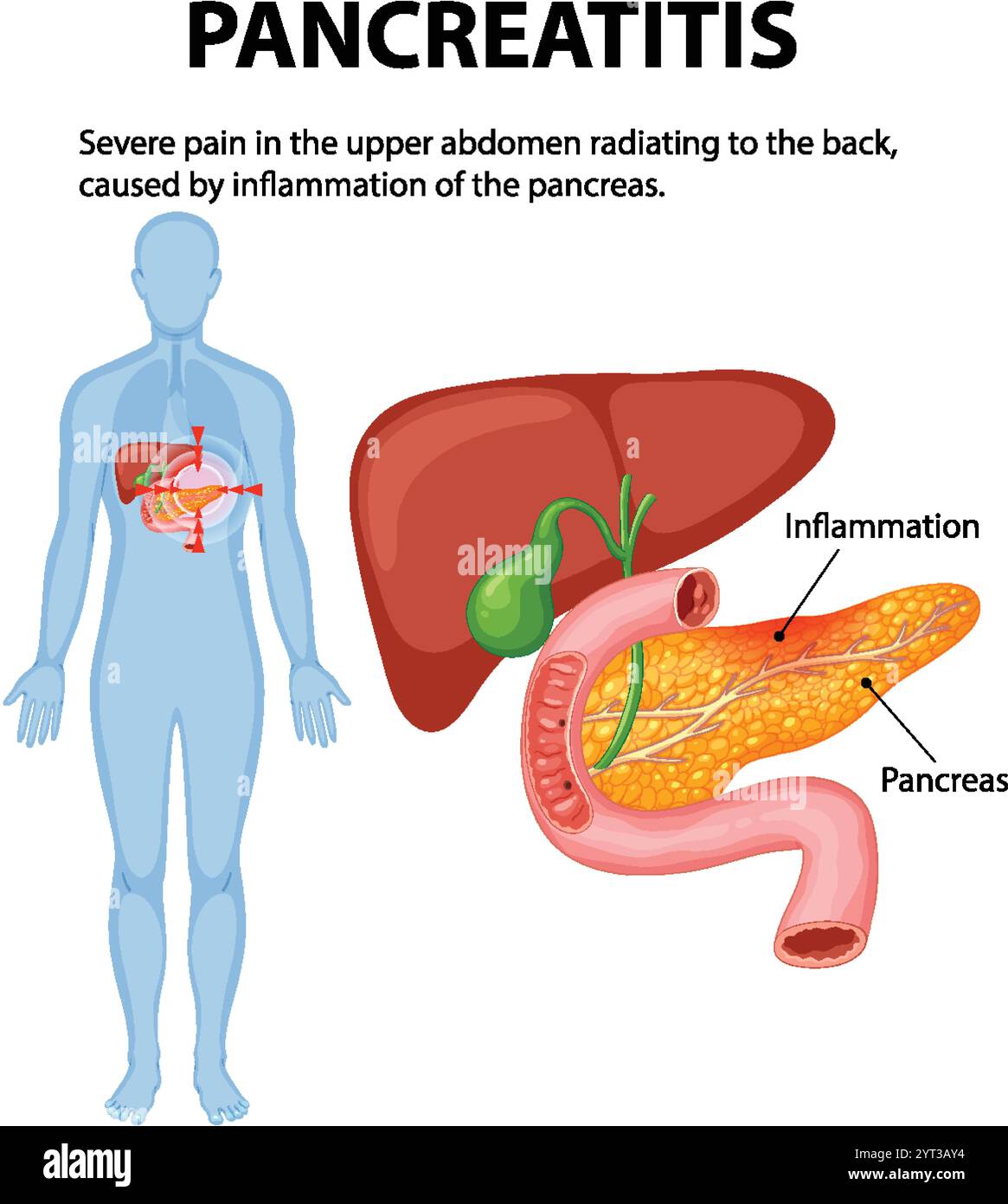 Illustration de l'inflammation du pancréas et de la douleur associée Illustration de Vecteur