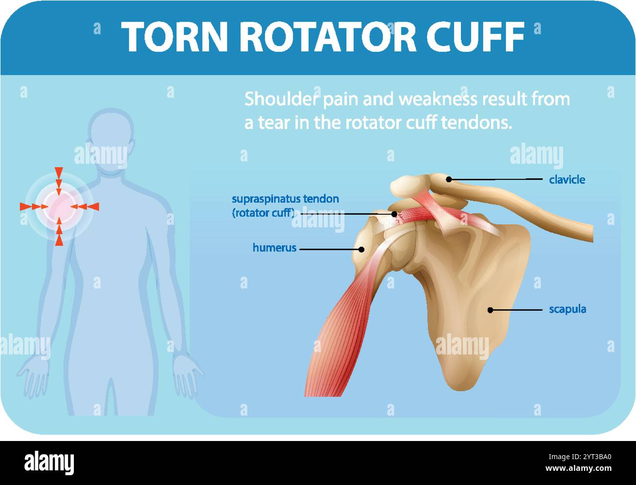 Illustration de l'anatomie de l'épaule et détails de la blessure Illustration de Vecteur