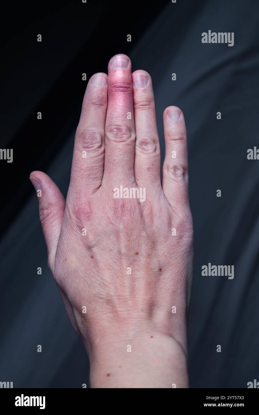 Cicatrisation du doigt en maillet après retrait de l'attelle du majeur après traumatisme articulaire Banque D'Images