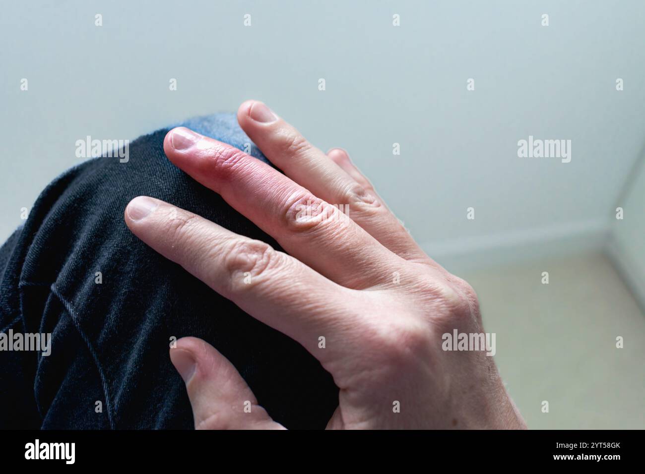 Cicatrisation du doigt en maillet après retrait de l'attelle du majeur après traumatisme articulaire Banque D'Images