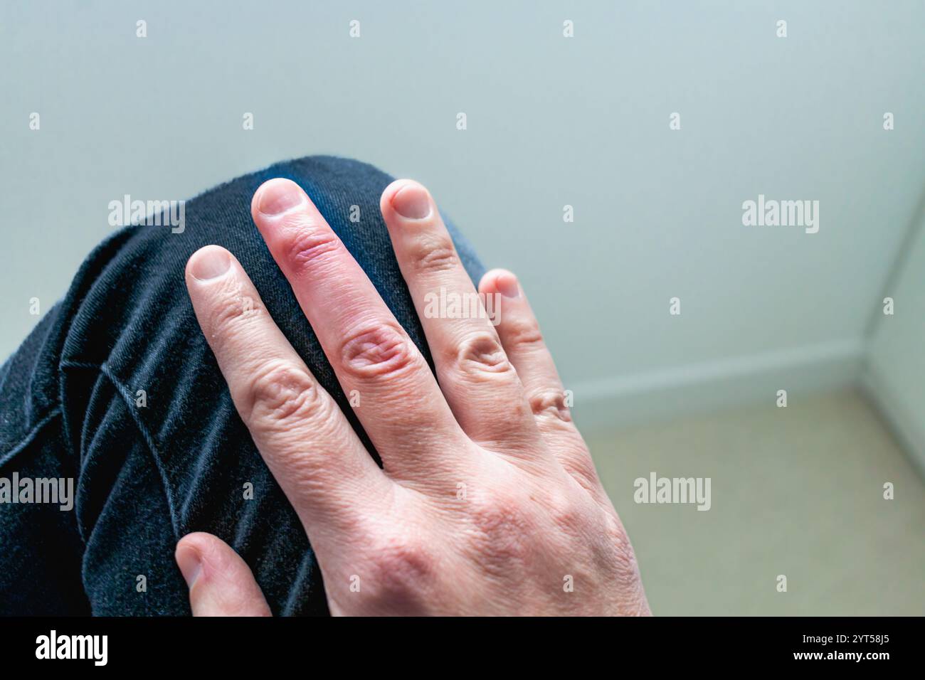 Cicatrisation du doigt en maillet après retrait de l'attelle du majeur après traumatisme articulaire Banque D'Images