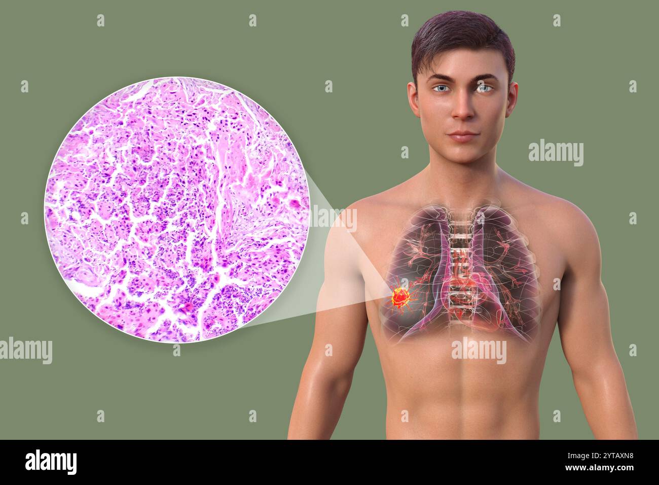 Illustration par ordinateur d'un homme atteint d'un cancer du poumon, accompagnée d'une micrographie légère d'un carcinome épidermoïde du poumon. Banque D'Images