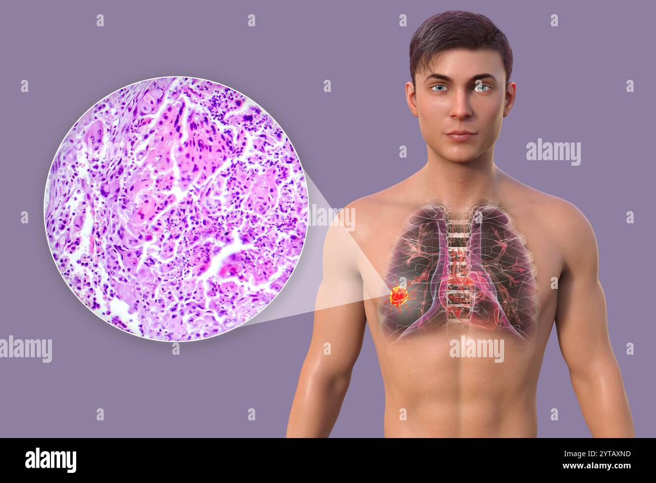 Illustration par ordinateur d'un homme atteint d'un cancer du poumon, accompagnée d'une micrographie légère d'un carcinome épidermoïde du poumon. Banque D'Images
