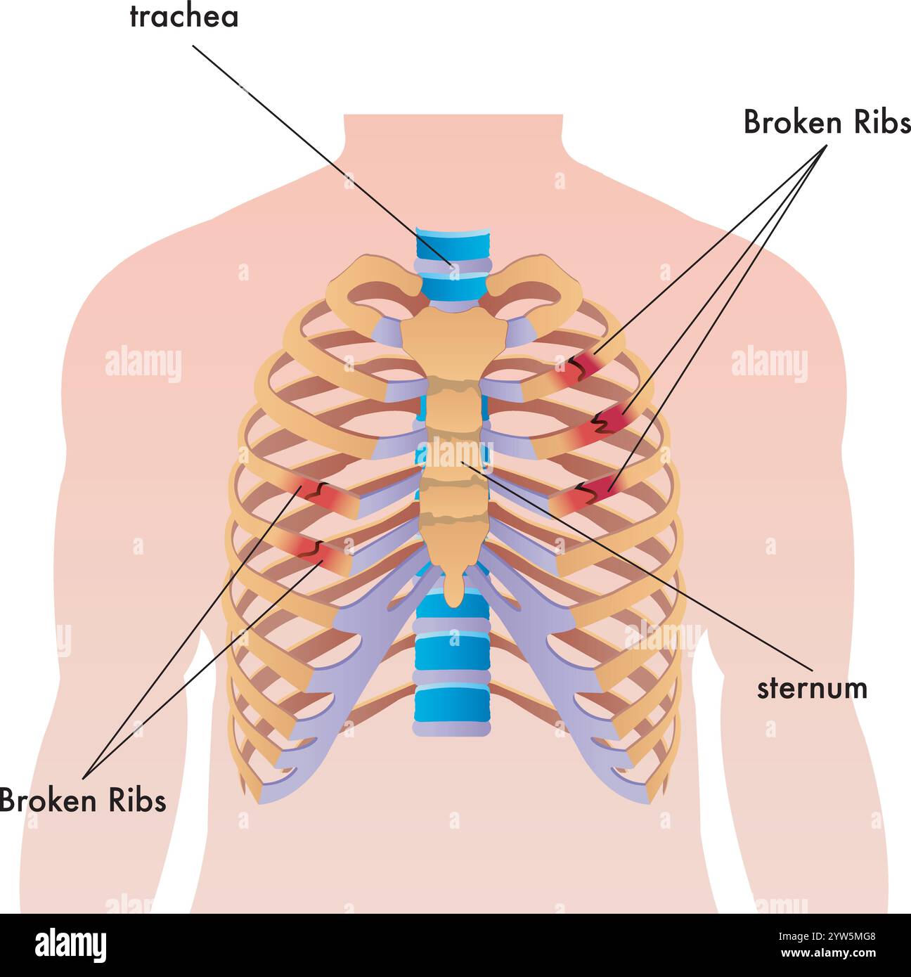 Illustration médicale de côtes cassées dans le corps humain, avec annotations. Illustration de Vecteur