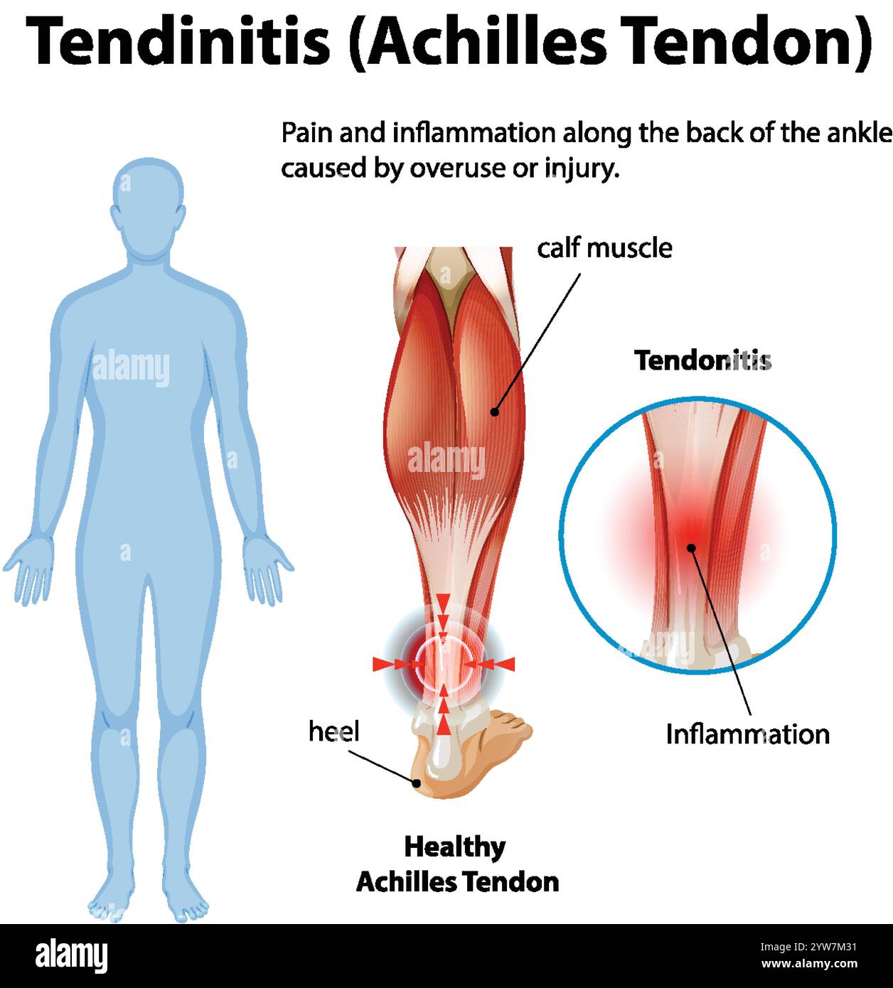 Diagramme montrant l'inflammation et la douleur du tendon d'Achille Illustration de Vecteur
