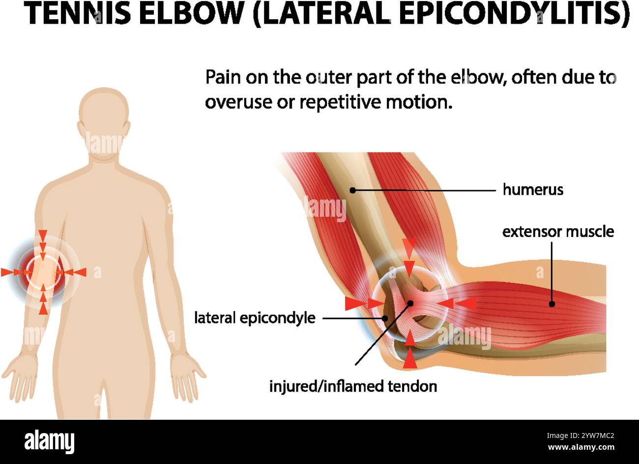 Illustration des symptômes du tennis elbow et de l'anatomie Illustration de Vecteur