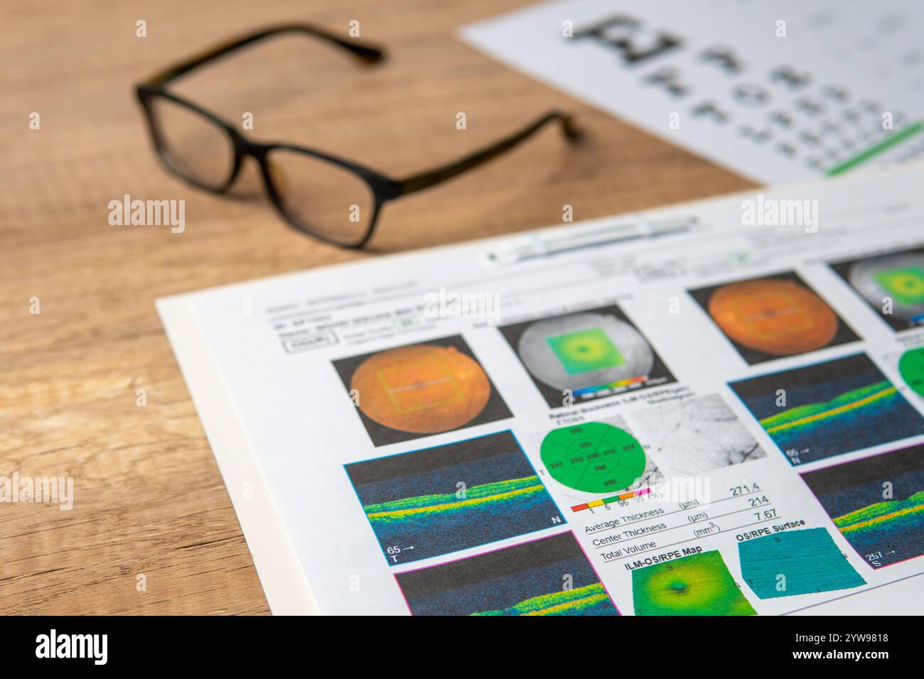 Une paire de lunettes et un rapport maculaire comprenant des graphiques oculaires et des scans OCT. Concept de santé oculaire et de soins de la vue. Banque D'Images