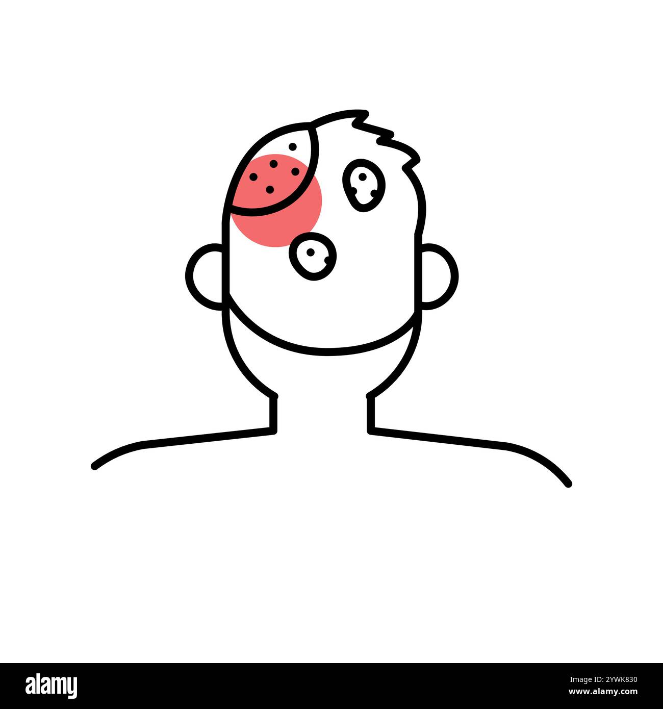 Icône de ligne de couleur d'alopécie areata. Maladies auto-immunes. Elément isolé par vecteur. Contour modifiable. Illustration de Vecteur