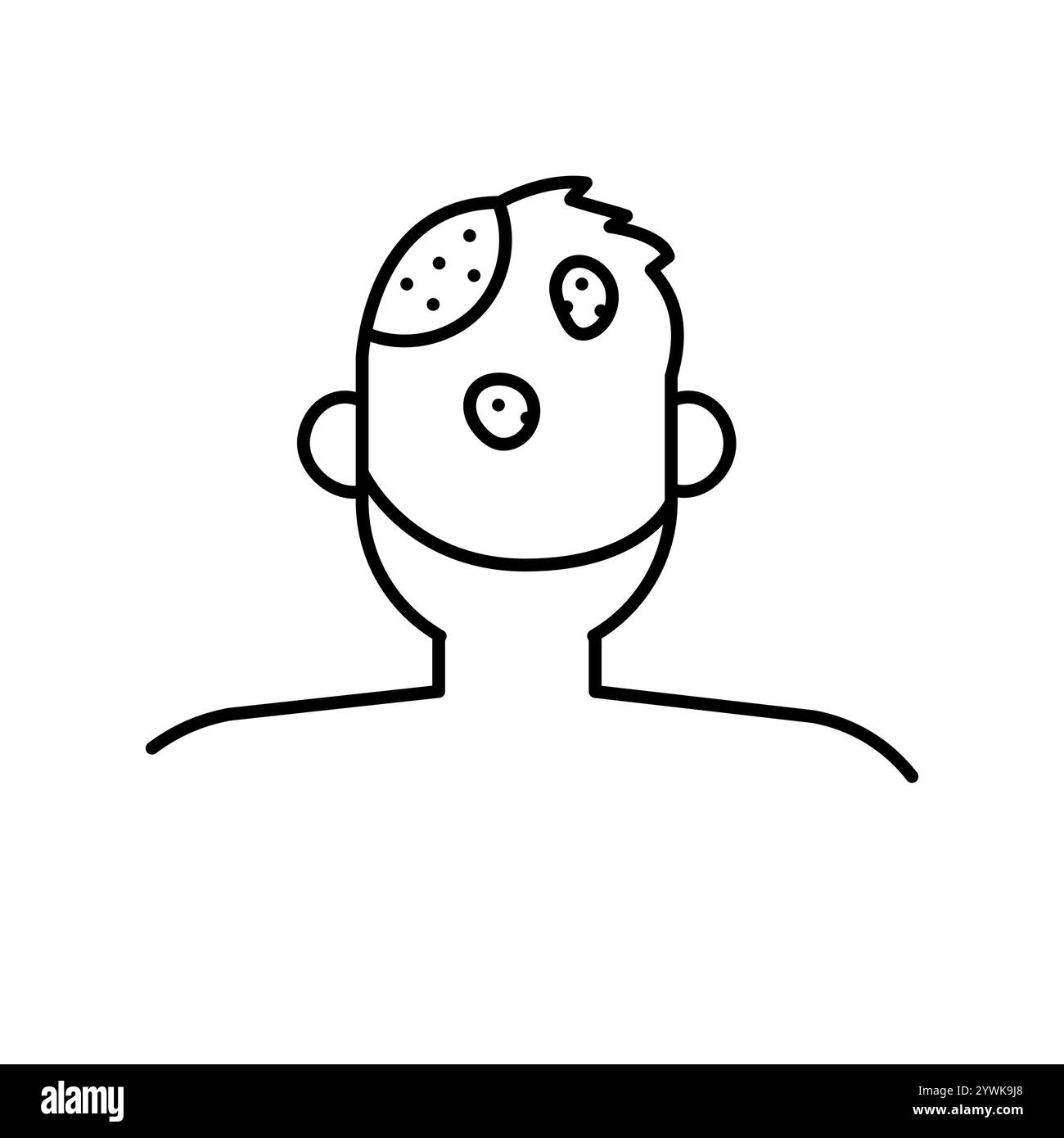 Icône de ligne de couleur d'alopécie areata. Maladies auto-immunes. Elément isolé par vecteur. Contour modifiable. Illustration de Vecteur