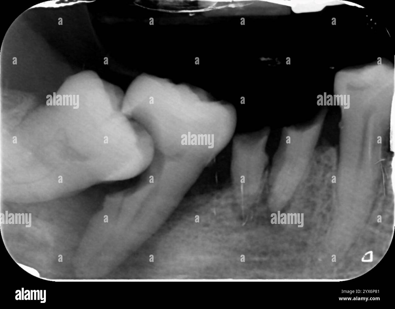 3M ESPE MC-64 Iso-Form Lot De 64 Couronnes Molaires