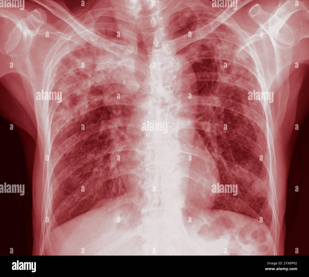 Radiographie colorée des poumons d'un malade atteint de tuberculose pulmonaire affectant les deux poumons. La tuberculose pulmonaire est causée par la bactérie Mycobacterium tuberculosis, qui se propage par la toux et les éternuements. Les bactéries créent des tubercules primaires, des lésions nodulaires des poumons. Les symptômes comprennent la fièvre, la perte de poids et la toux de sang. Le traitement est avec des antibiotiques à long terme. Banque D'Images