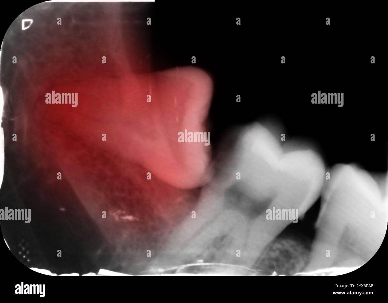 Radiographie périapicale colorée d'une dent de sagesse inférieure droite incluse. La dent de sagesse pousse horizontalement, impactant sur les molaires à côté et pourrait les pousser hors de l'alignement. Une radiographie périapicale montre la dent entière, de la couronne à la pointe de la racine. Banque D'Images