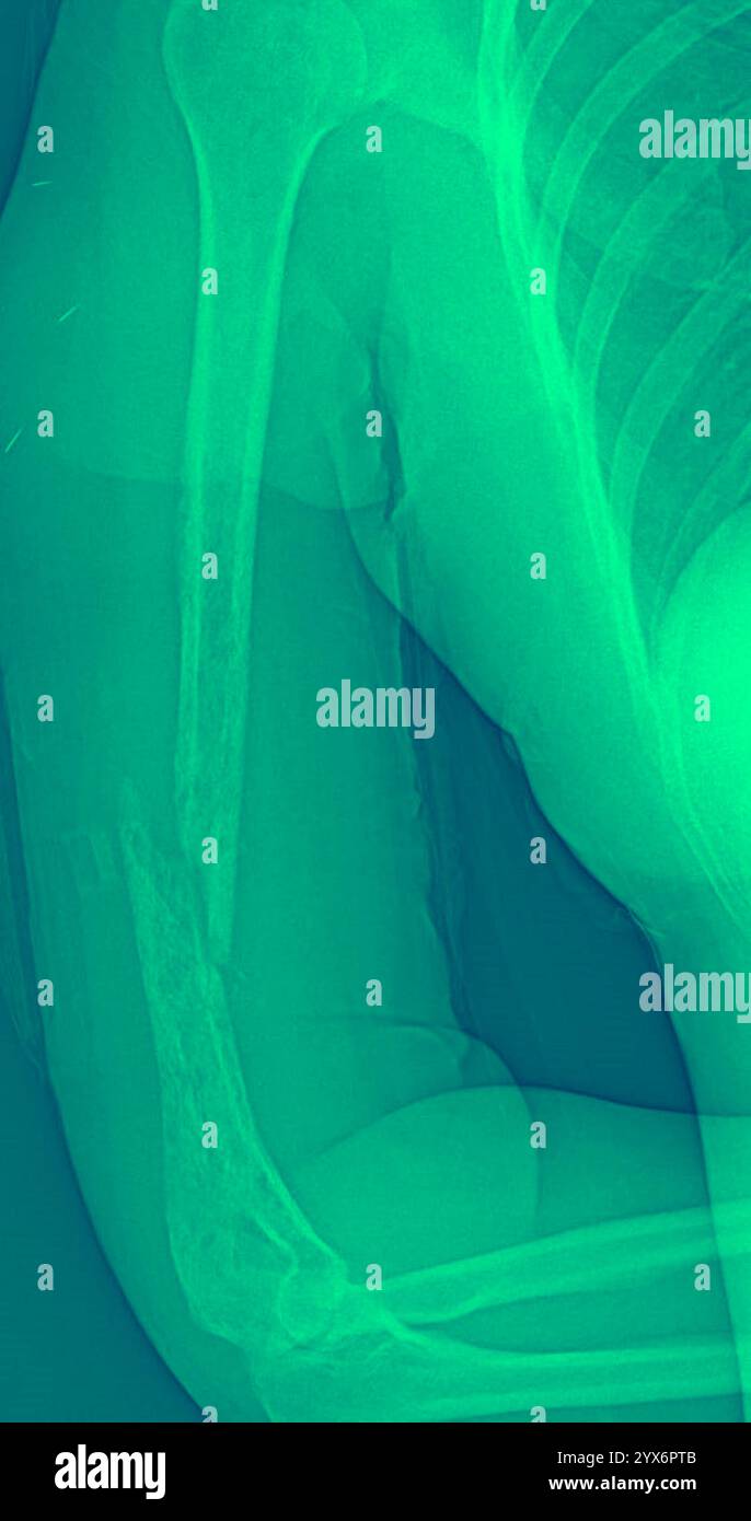 Radiographie colorée d'un humérus fracturé (os de la partie supérieure du bras). Il s'agit d'une fracture pathologique, qui est une fracture causée par un affaiblissement de l'os plutôt que par un traumatisme. Banque D'Images