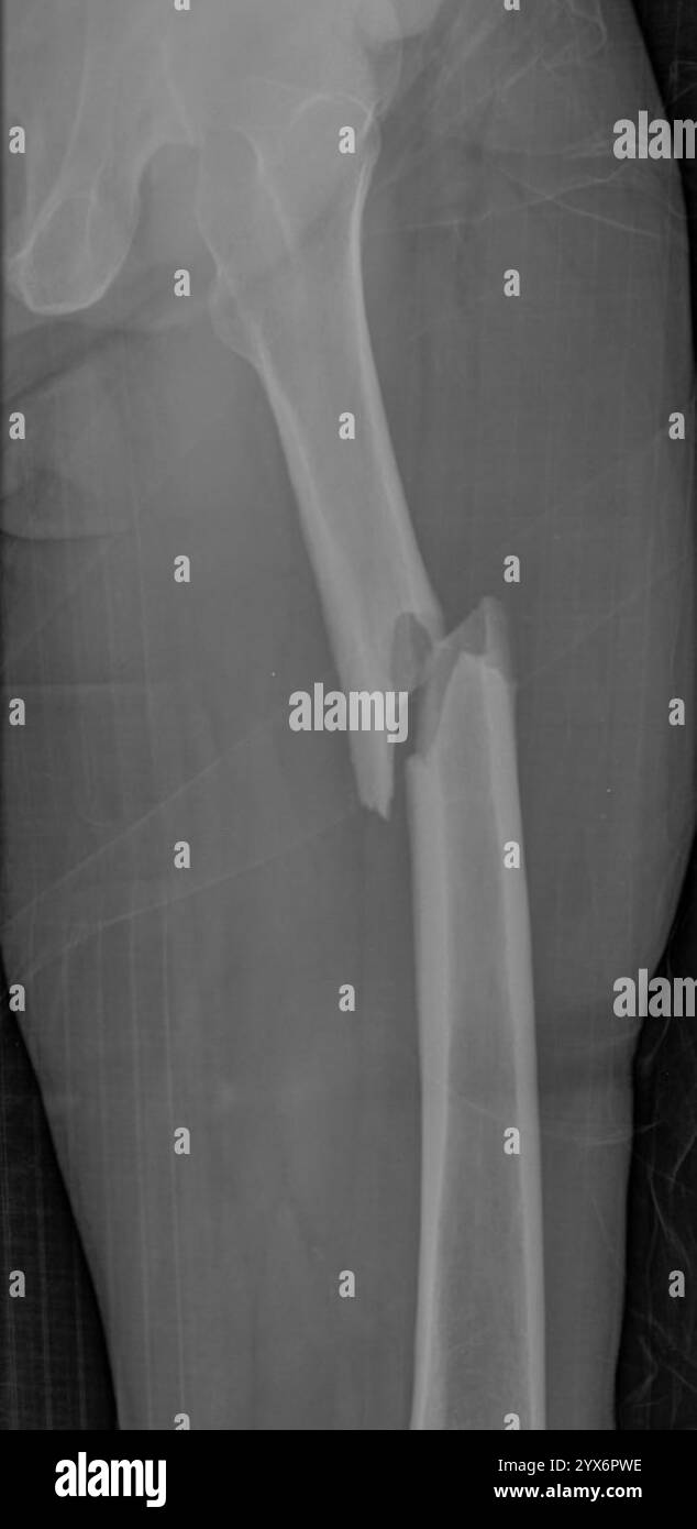 Radiographie d'un fémur fracturé (os de cuisse). Il y a aussi un kyste osseux anévrismal dans le col du fémur. Il s'agit d'une fracture pathologique, qui est une fracture causée par un affaiblissement de l'os plutôt que par un traumatisme. Les kystes osseux anévrysmaux sont des lésions sanguines dans l'os qui peuvent se dilater ou se développer, affaiblissant l'os. Ils se produisent le plus souvent dans le tibia et le fémur. Banque D'Images