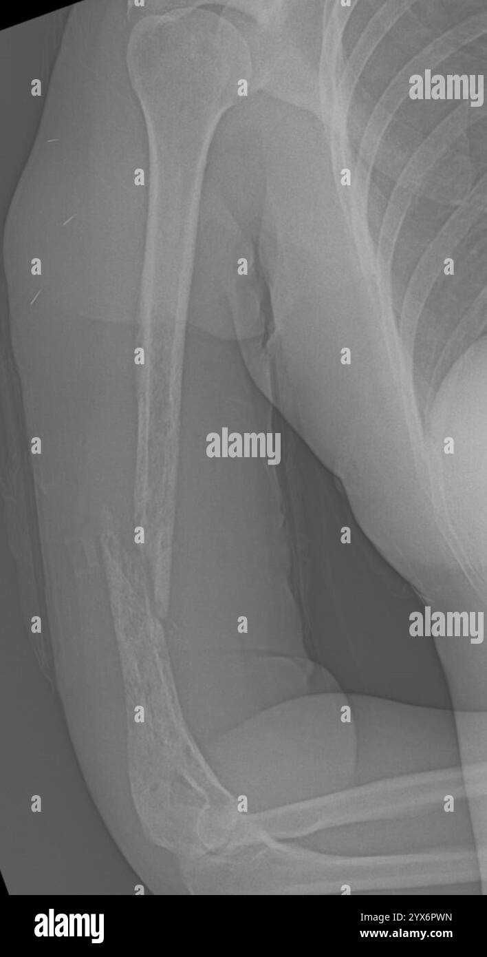 Radiographie d'un humérus fracturé (os du bras supérieur). Il s'agit d'une fracture pathologique, qui est une fracture causée par un affaiblissement de l'os plutôt que par un traumatisme. Banque D'Images