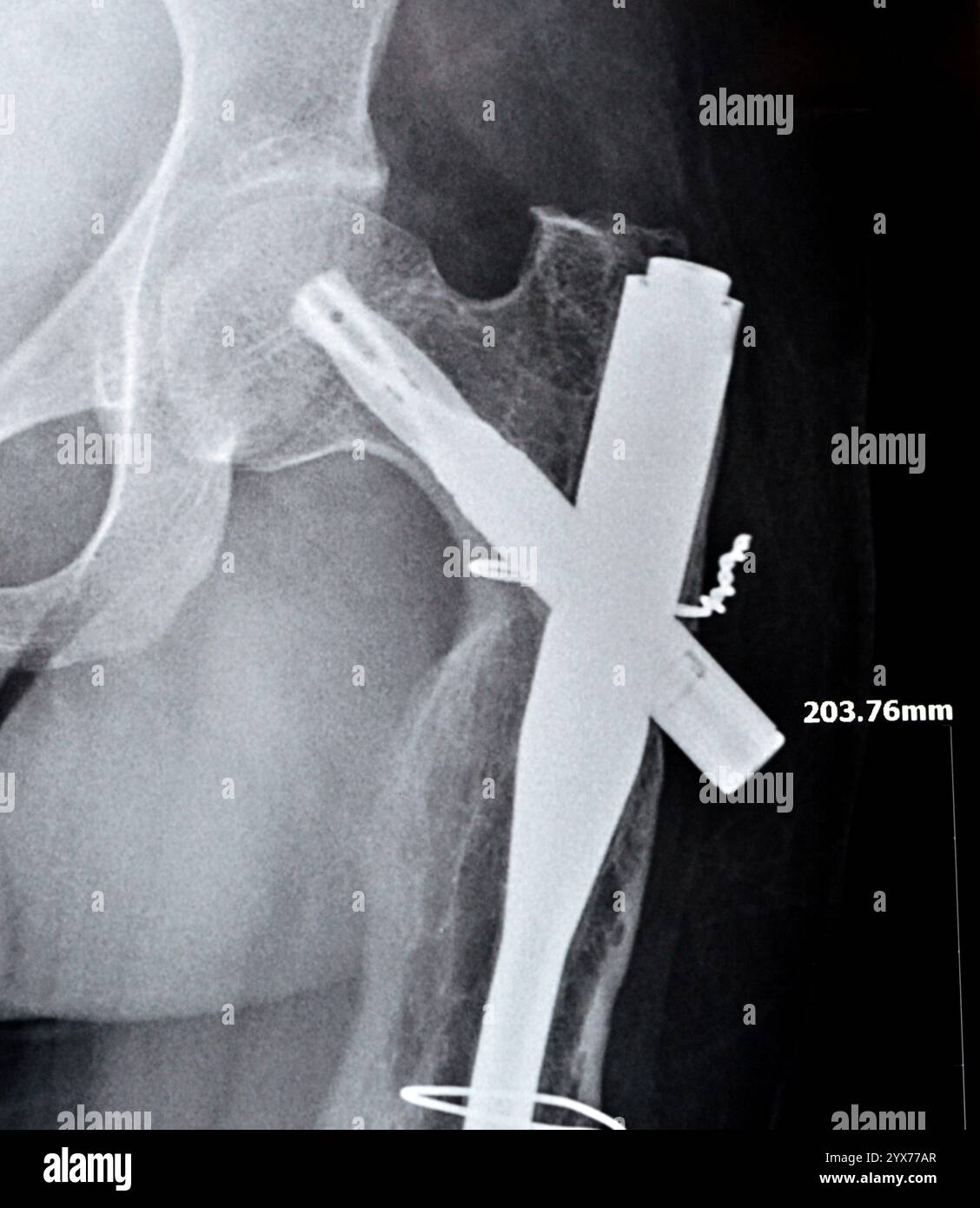 Radiographie montrant une interférence opératoire avec une fracture de la diaphyse fémorale LT transfixatrice intra-médullaire avec formation de cal ossifié, fixation interne Banque D'Images
