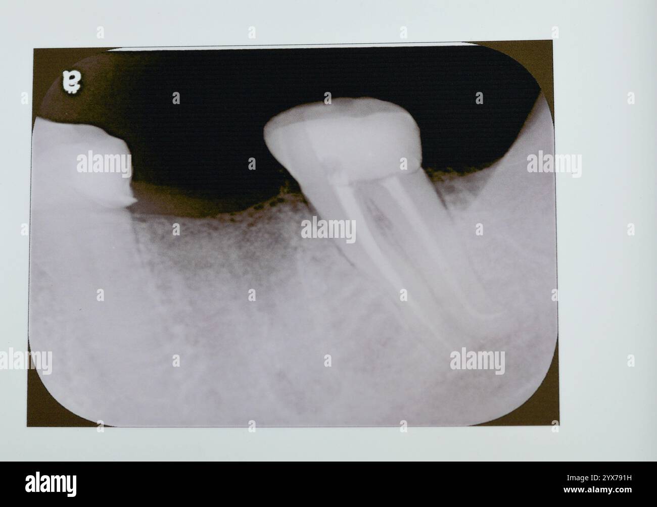 Radiographie périapicale molaire inférieure avec traitement canalaire avec remplissage coronaire sans couronne prothétique, mise en évidence d'une radiotransparence affectant la bifurque Banque D'Images