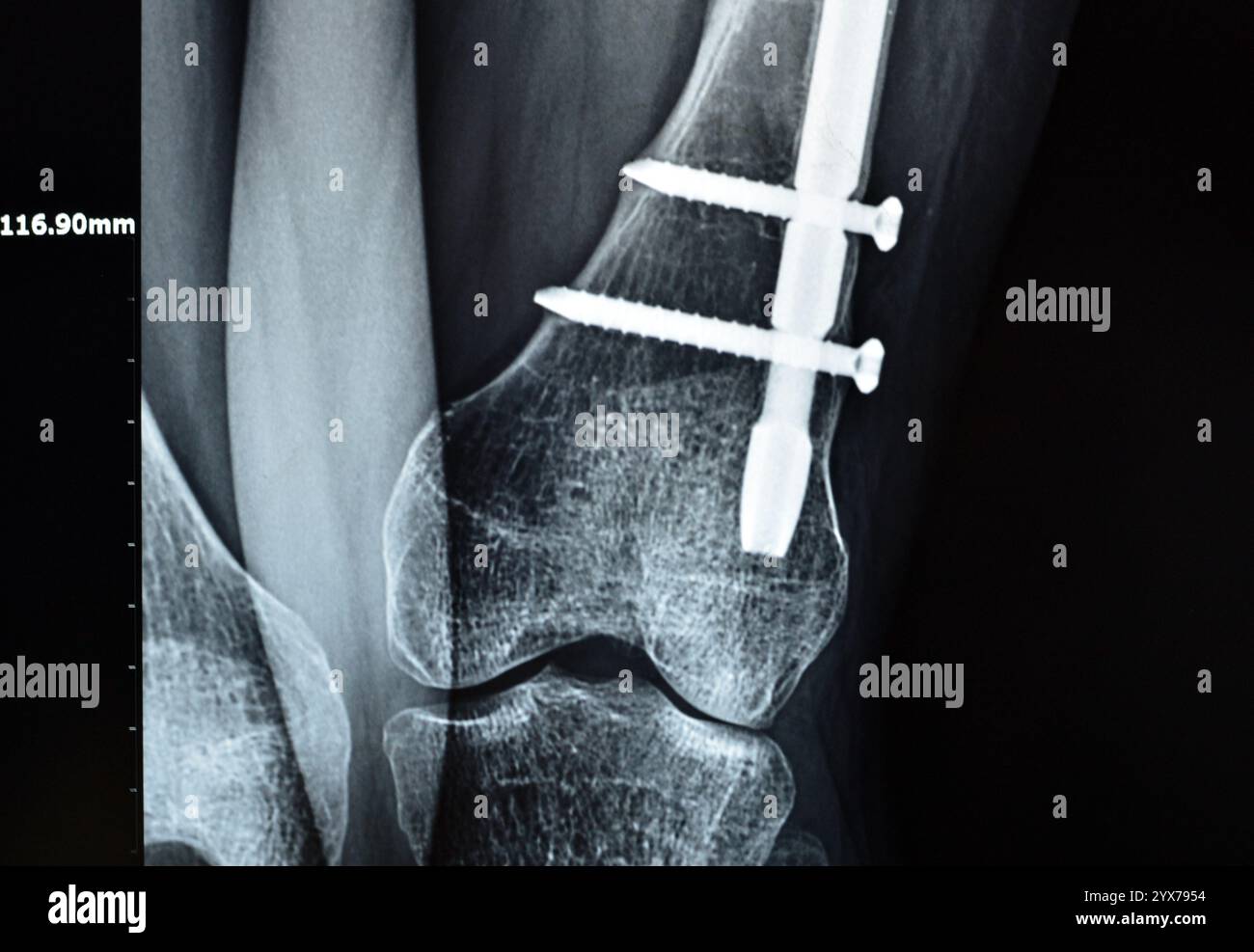 Radiographie montrant une interférence opératoire avec une fracture de la diaphyse fémorale LT transfixatrice intra-médullaire avec formation de cal ossifié, fixation interne Banque D'Images