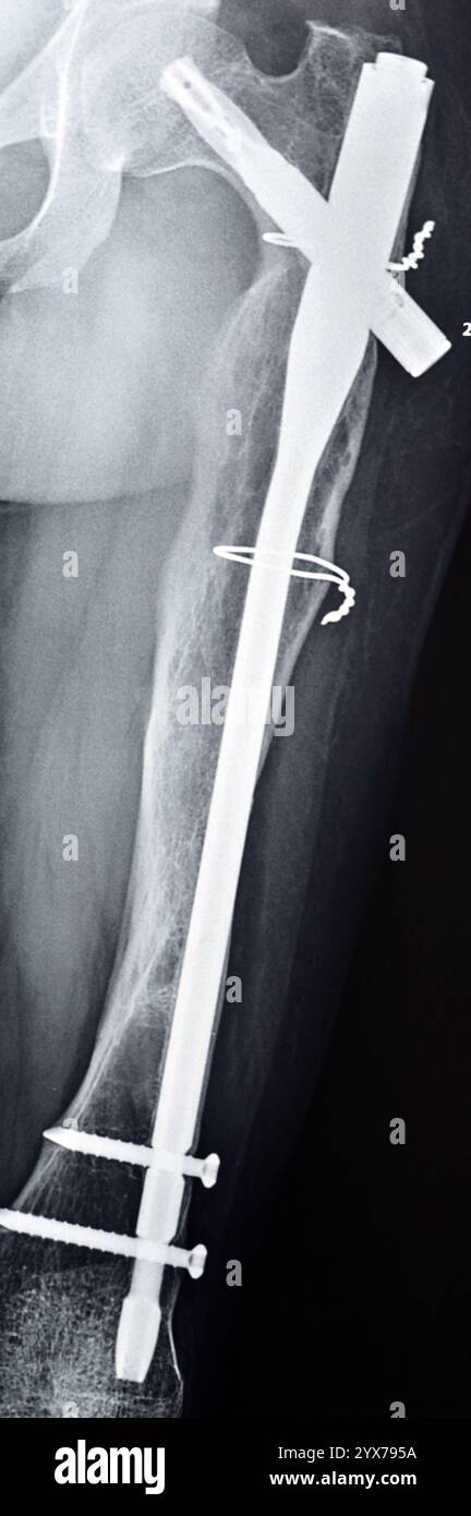Radiographie montrant une interférence opératoire avec une fracture de la diaphyse fémorale LT transfixatrice intra-médullaire avec formation de cal ossifié, fixation interne Banque D'Images