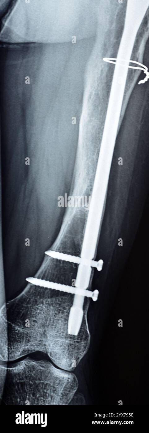 Radiographie montrant une interférence opératoire avec une fracture de la diaphyse fémorale LT transfixatrice intra-médullaire avec formation de cal ossifié, fixation interne Banque D'Images