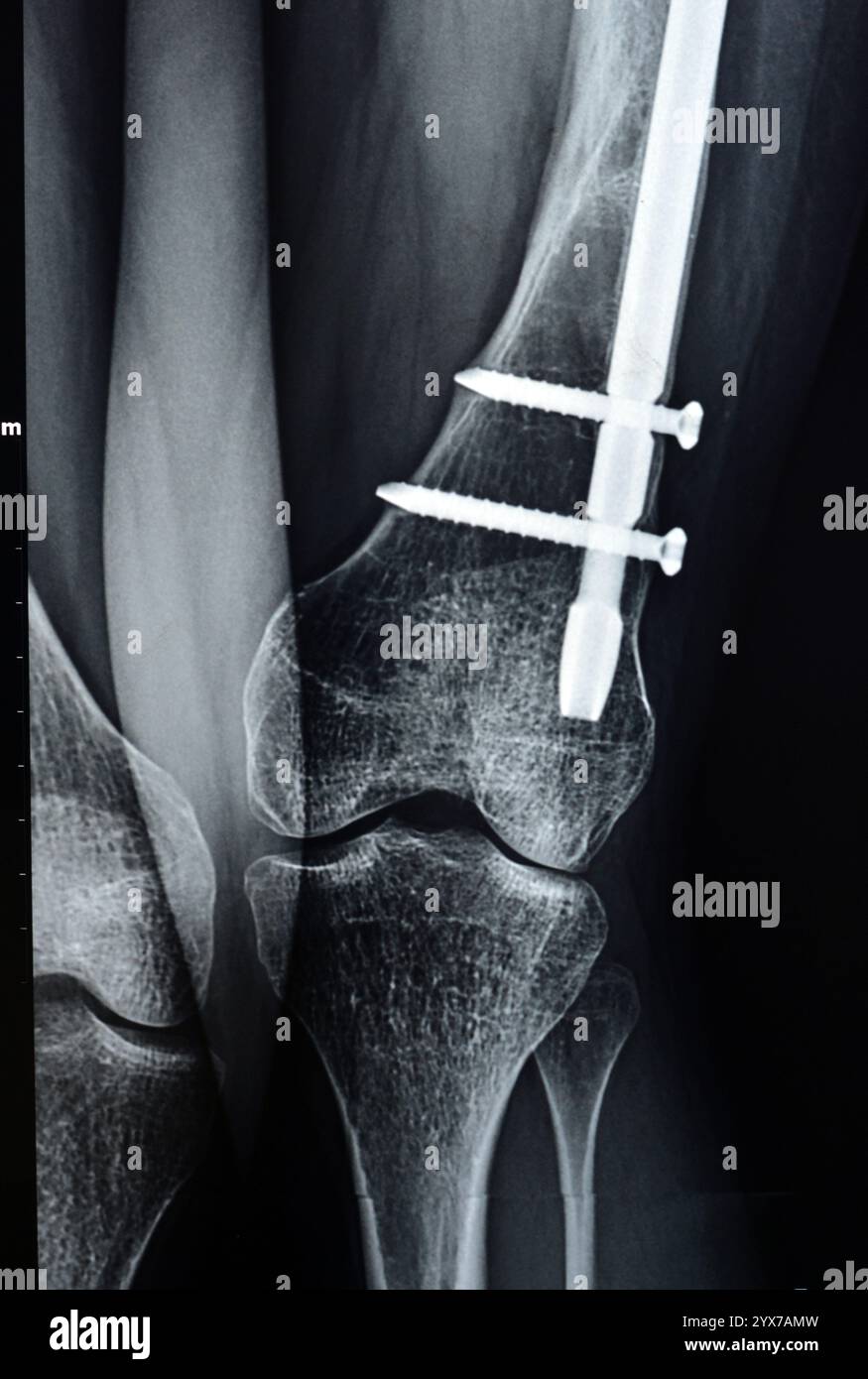 Radiographie montrant une interférence opératoire avec une fracture de la diaphyse fémorale LT transfixatrice intra-médullaire avec formation de cal ossifié, fixation interne Banque D'Images