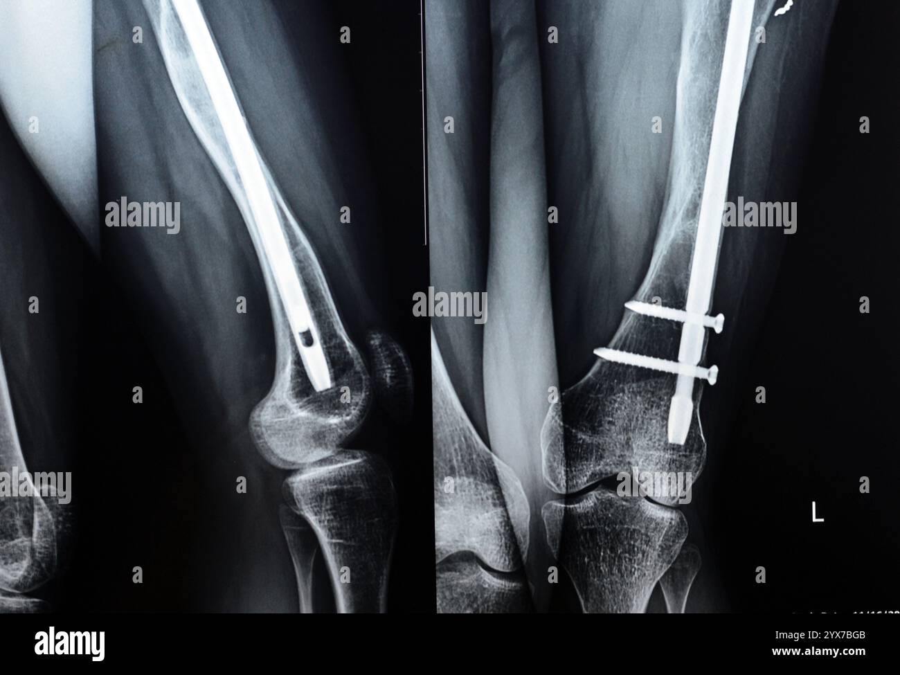 Radiographie montrant une interférence opératoire avec une fracture de la diaphyse fémorale LT transfixatrice intra-médullaire avec formation de cal ossifié, fixation interne Banque D'Images