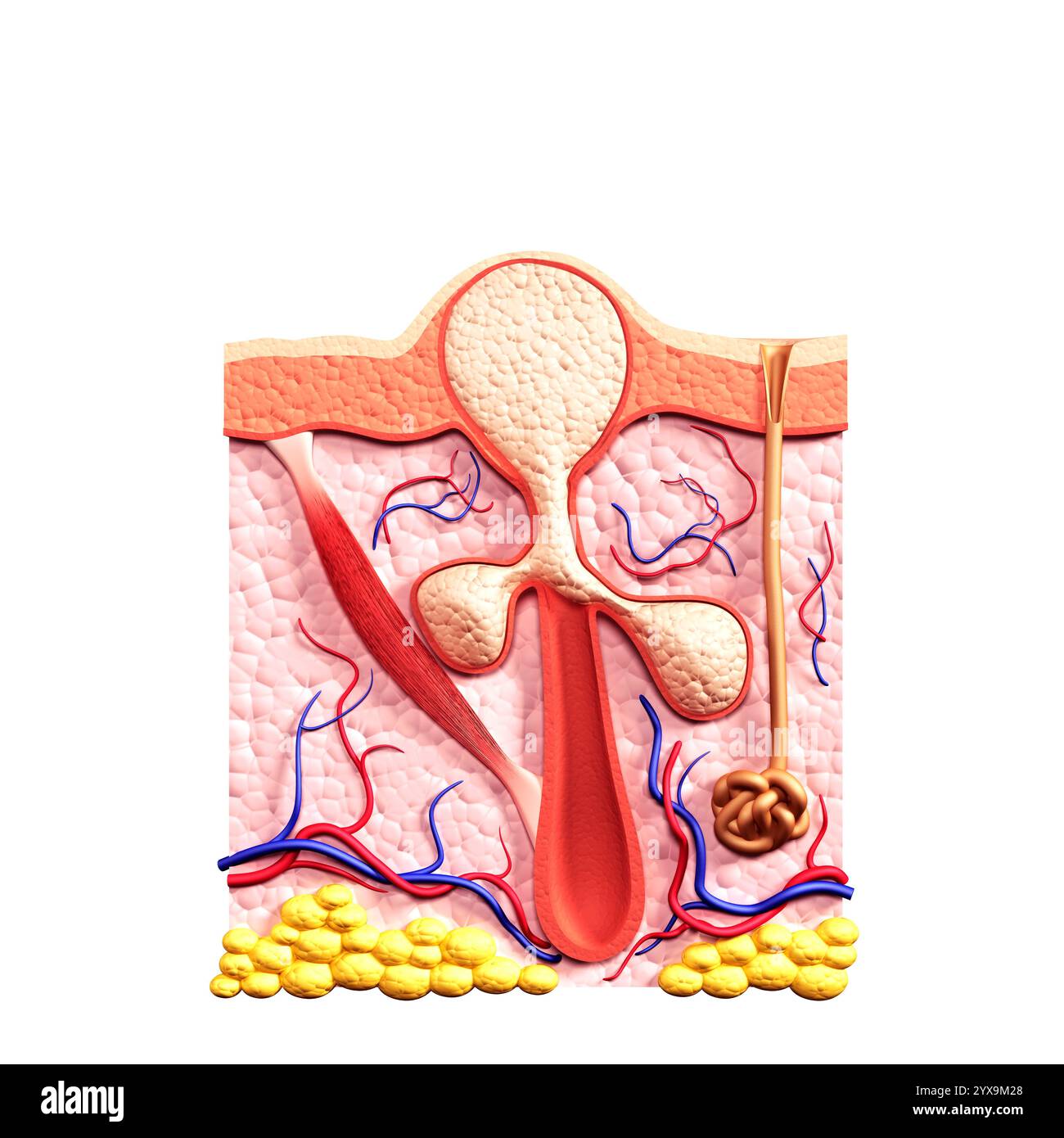 Coupe de la peau montrant follicule de cheveux remplis de sébum, de pus ou de globules blancs, et des glandes sébacées, causant un whitehead bouton ou l'acné. Médicaux 3 Banque D'Images