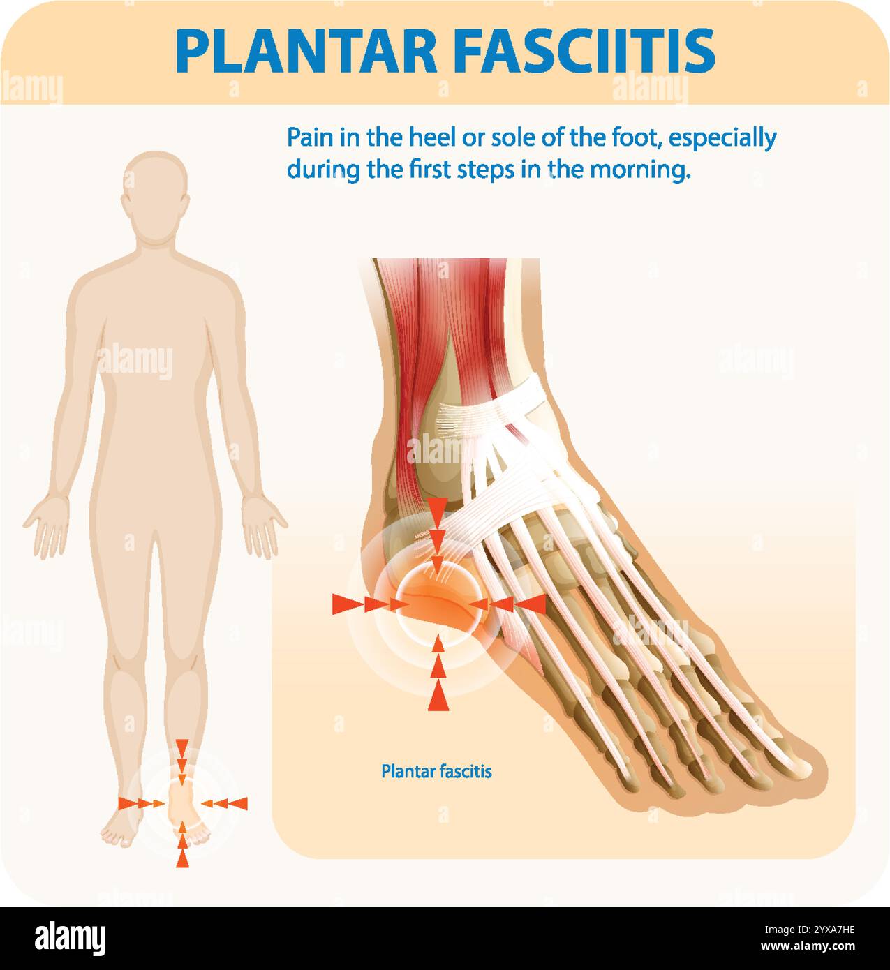 Illustration de l'anatomie du pied et des points douloureux Illustration de Vecteur