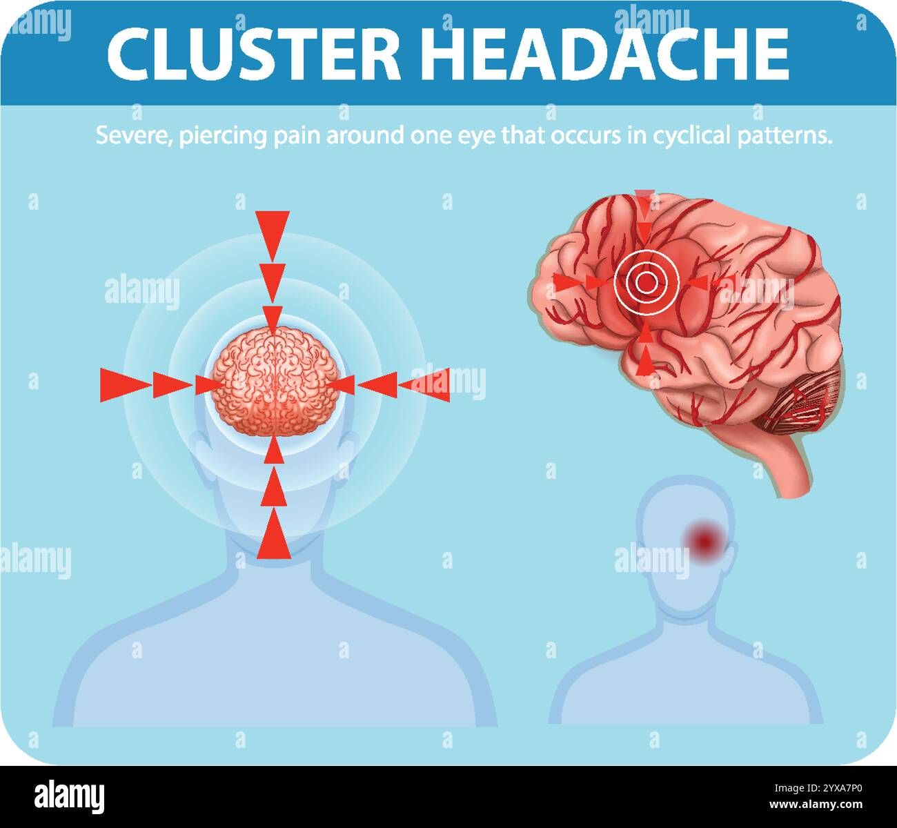Illustration des schémas de douleur dans les céphalées en grappe Illustration de Vecteur