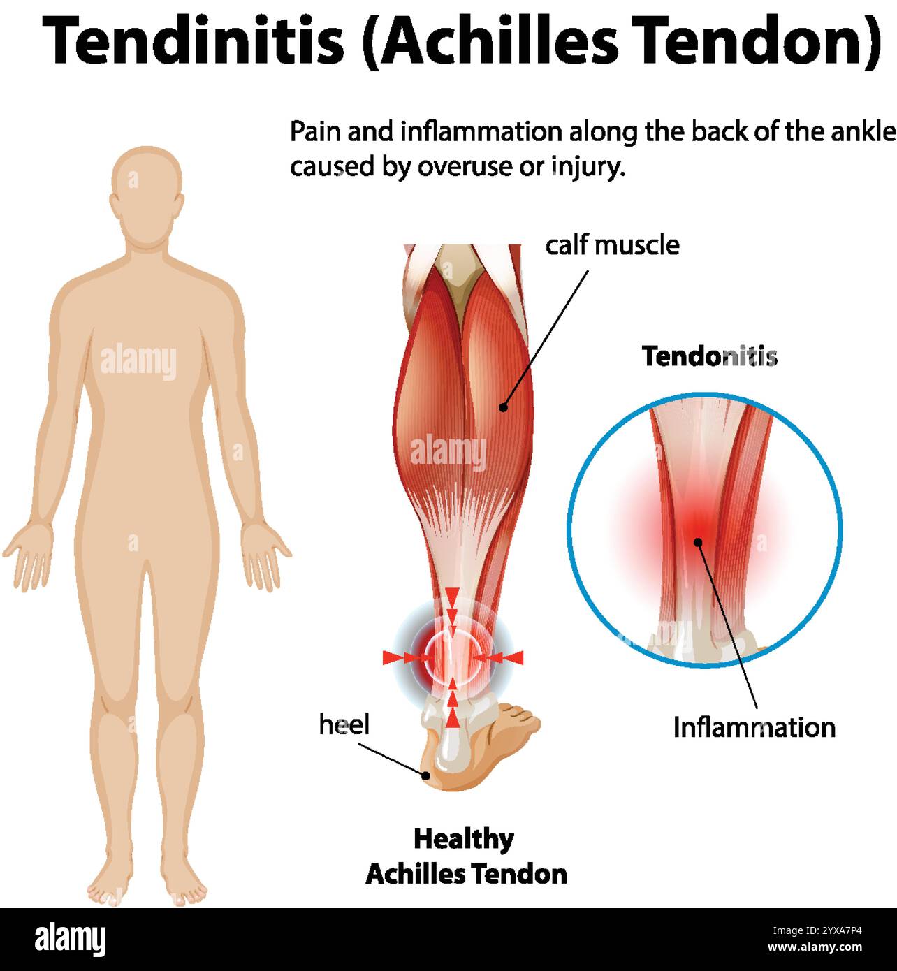 Diagramme montrant l'inflammation et la douleur du tendon d'Achille Illustration de Vecteur