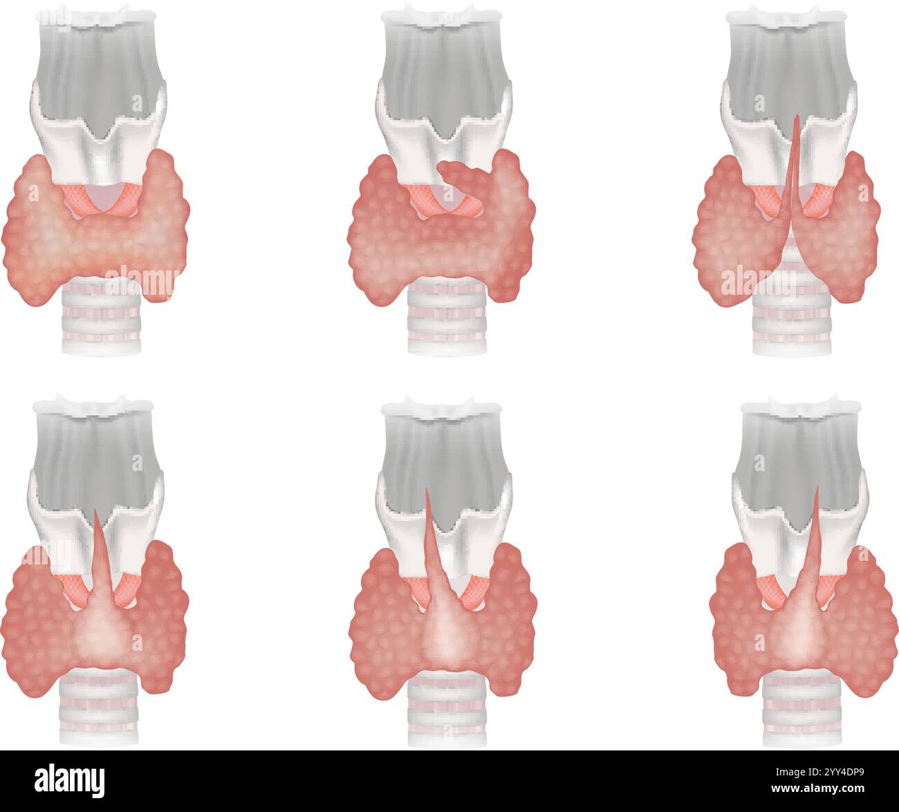 Variations du lobe pyramidal dans l'anatomie thyroïdienne et le lobe ...