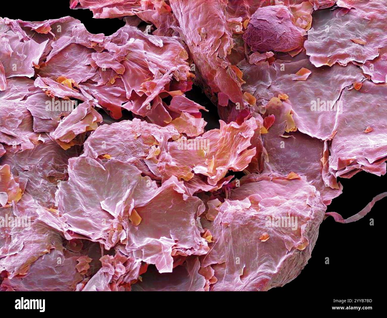 Pellicules. Micrographie électronique à balayage coloré (MEB) de la peau morte du cuir chevelu (pellicules), une condition où il y a une perte excessive de cellules mortes de la peau. Les pellicules peuvent être le résultat du psoriasis, d'une infection fongique, ou de la surproduction de sébum, la sécrétion des glandes sébacées associée aux follicules pileux. Grossissement : x35 lorsqu'il est imprimé à 10 centimètres de large. Banque D'Images