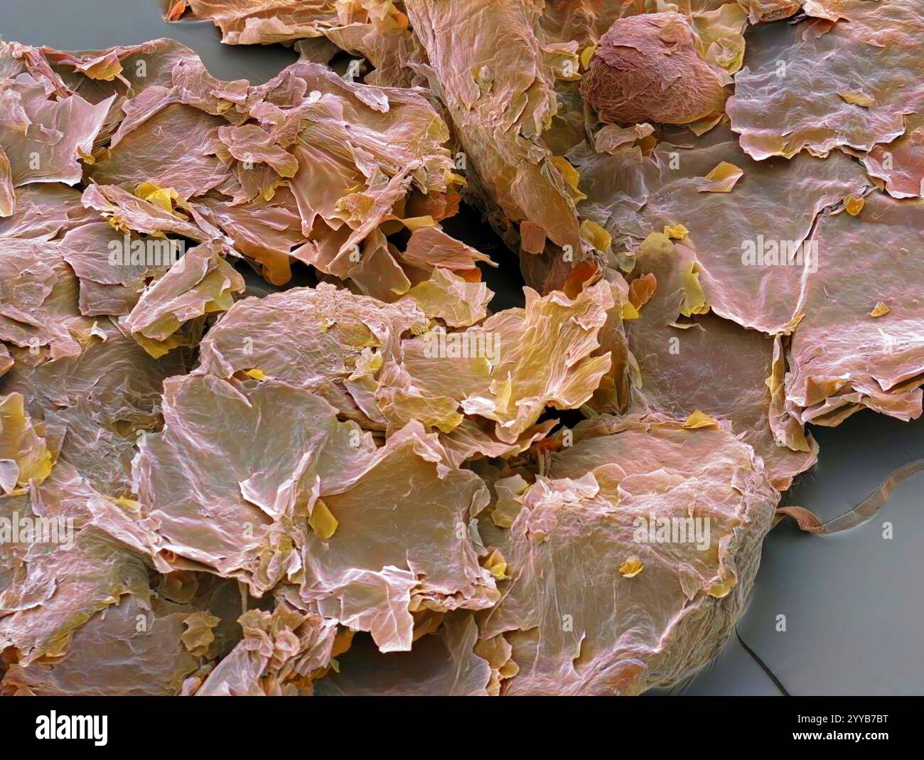 Pellicules. Micrographie électronique à balayage coloré (MEB) de la peau morte du cuir chevelu (pellicules), une condition où il y a une perte excessive de cellules mortes de la peau. Les pellicules peuvent être le résultat du psoriasis, d'une infection fongique, ou de la surproduction de sébum, la sécrétion des glandes sébacées associée aux follicules pileux. Grossissement : x35 lorsqu'il est imprimé à 10 centimètres de large. Banque D'Images