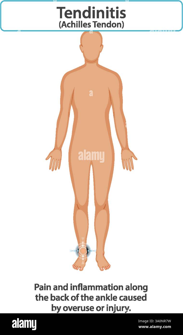 Diagramme montrant la douleur et l'inflammation du tendon d'Achille Illustration de Vecteur