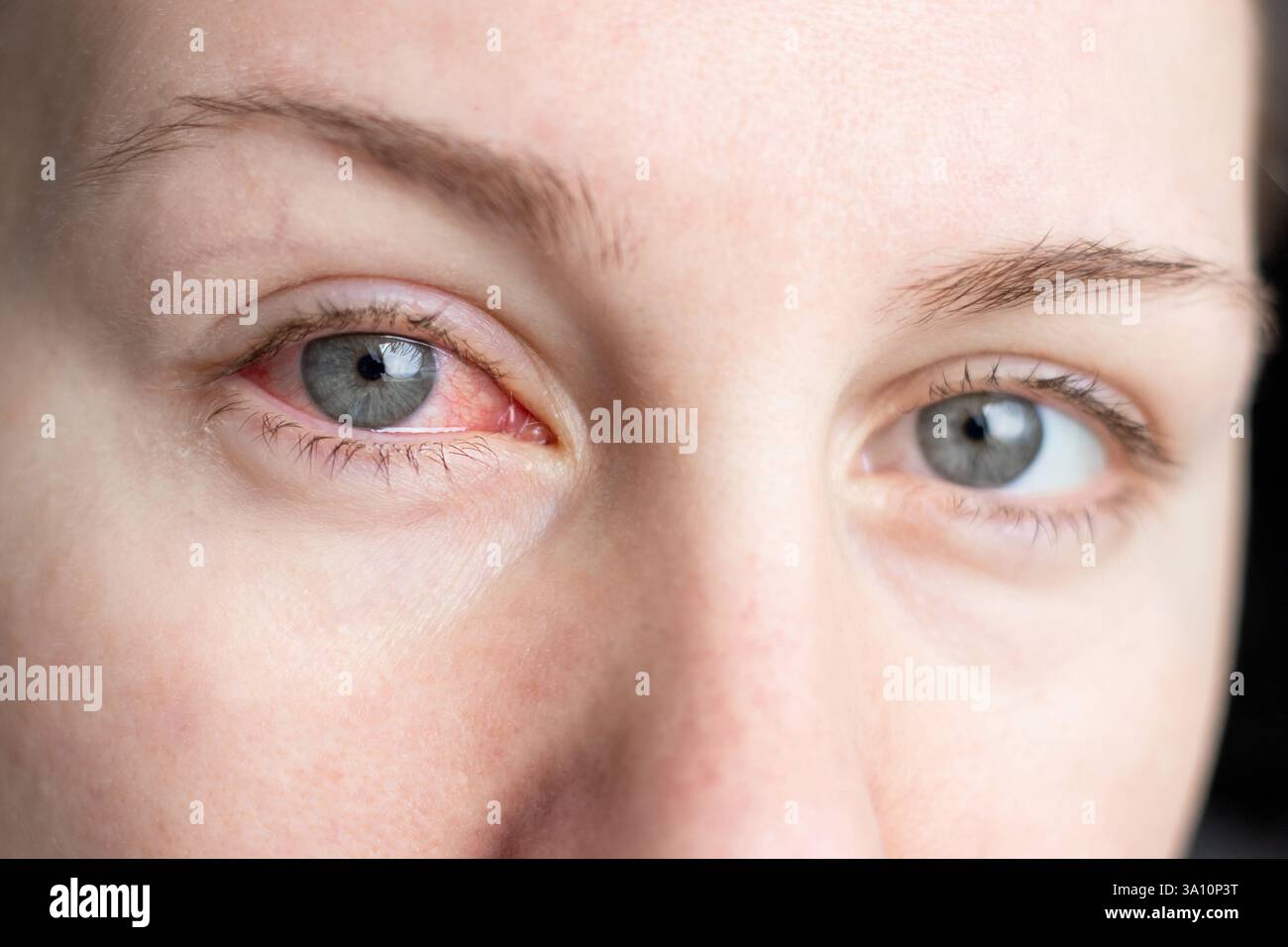 Gros plan du visage féminin avec un œil rouge souffrant de conjonctivite infectieuse Banque D'Images