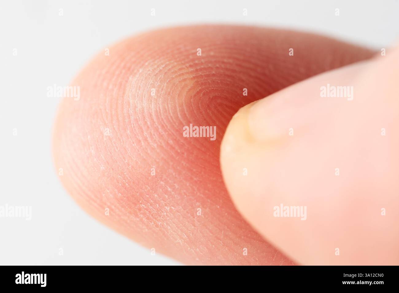 Blessure avec cloque de doigt humain vue macro en gros plan Banque D'Images