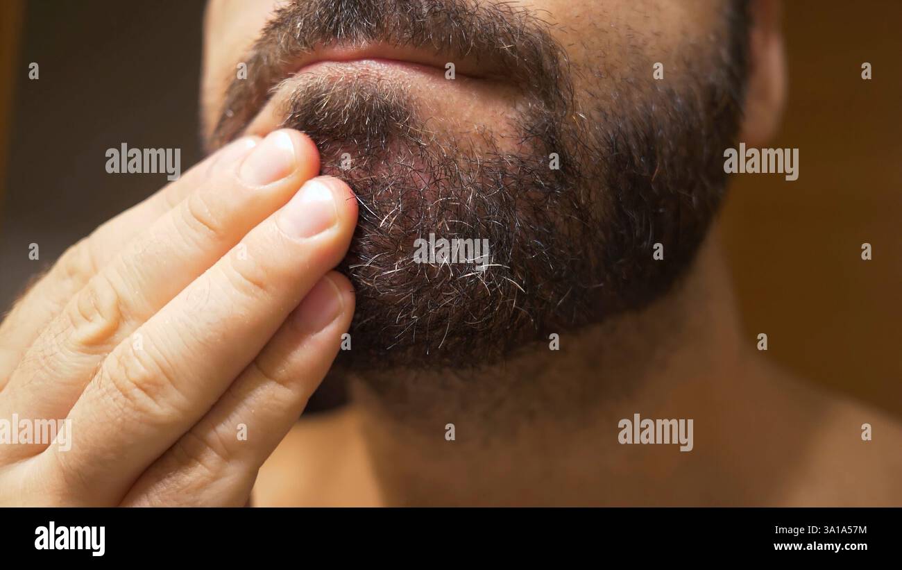 Détail du menton de l'homme avec une dermatite séborrhéique dans la zone de la barbe. La peau sèche se déchèche et provoque des démangeaisons et des pellicules. Banque D'Images