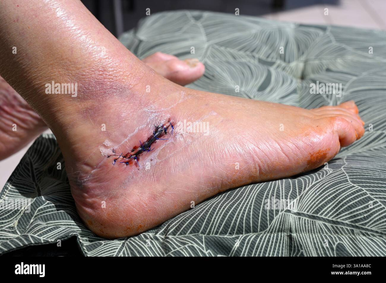 Cicatrice après une opération avec points de suture, après une fracture osseuse du talon Banque D'Images