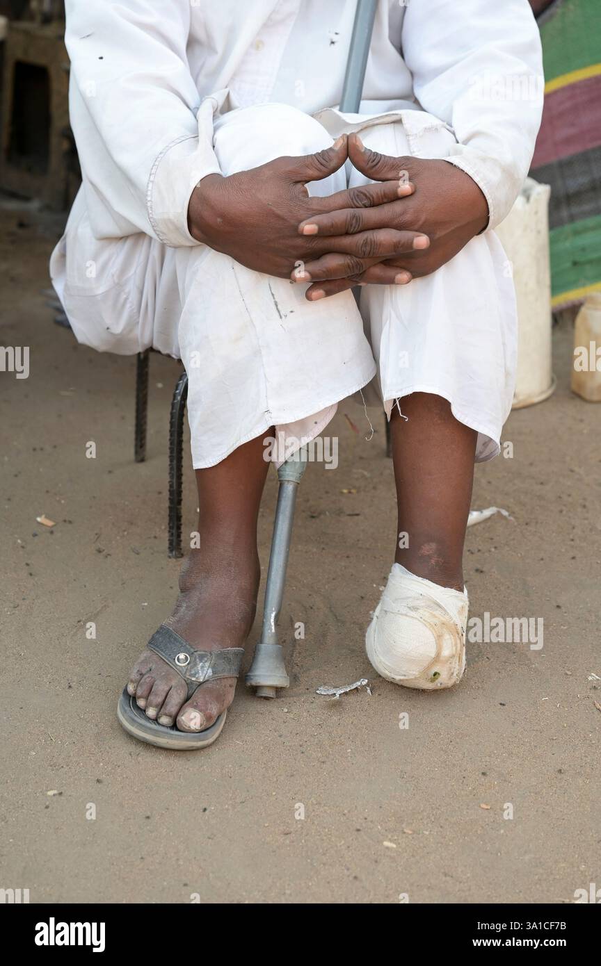 SOUDAN DU SUD, État du Haut-Nil, ville de Renk, centre de transit des réfugiés du HCR pour les réfugiés et les rapatriés de la guerre soudanaise, victime de guerre Hamad Atiab Flüchtlinge Hamad de Khartum a perdu une jambe dans l'explosion d'une bombe / SÜDSUDAN, État du Haut-Nil, Stadt Renk, Flüchtling aus dem Sudan suchen Schutz vor dem dem dem dem Krieg, UNHCR transit Fuß BEI Renk, Flüchtlingslager und Kriegsopfer Hamad Atiab Hamad aus Kriegsopfer, Hat seinen Banque D'Images
