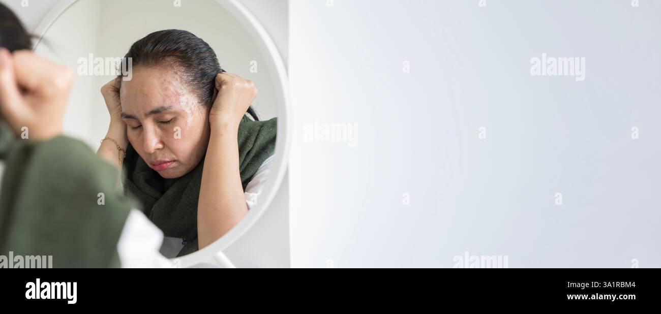 Anti rides vieillissement, inquiétude puberté jeune femme asiatique, stressé regardant dans le miroir, allergie présentant une réaction allergique de cosmétique sur le visage. Beauté, h Banque D'Images