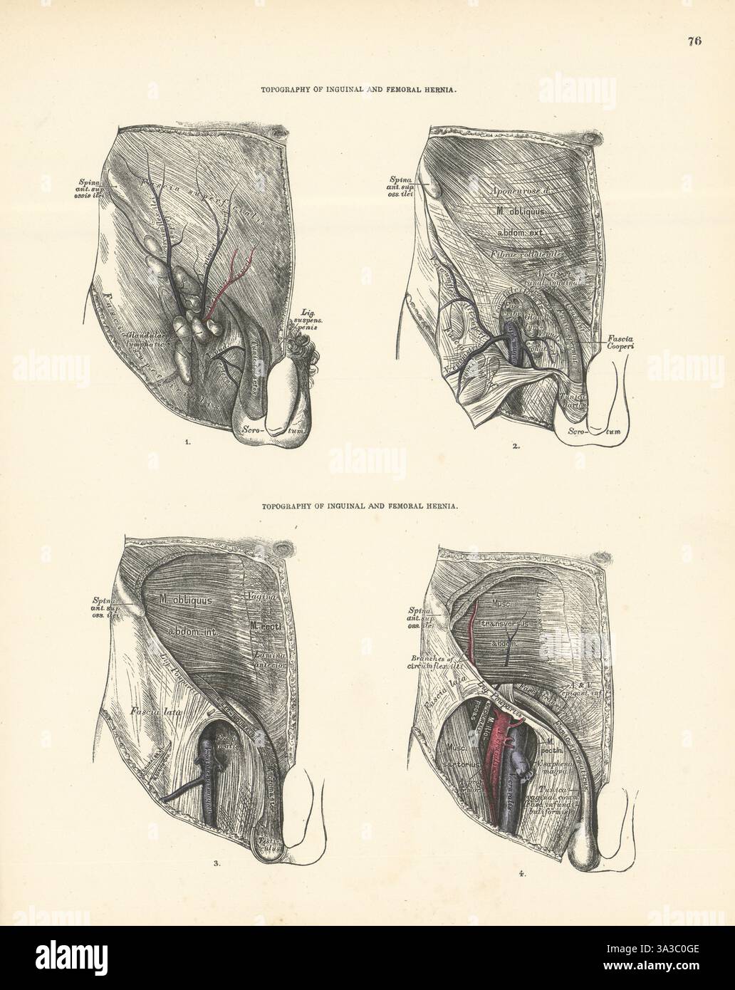 Anatomie. Hernie inguinale et fémorale topographie 1880 ancienne photo d'impression antique Banque D'Images