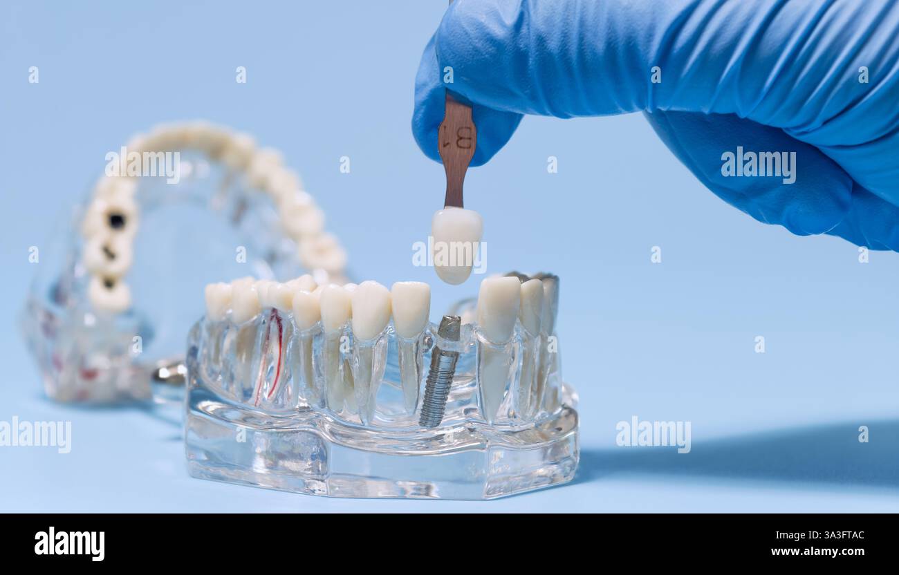 Adaptation des couleurs des implants dentaires avec guide de nuance Banque D'Images