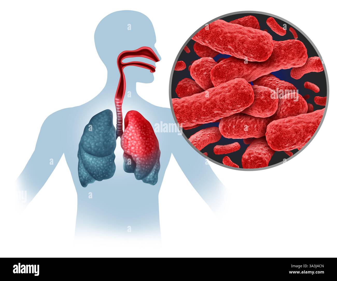 Épidémie d'infection à Mycobacterium tuberculosis et transmission de la tuberculose en tant qu'infection bactérienne contagieuse due à des bactéries infectieuses infectant les poumons Banque D'Images
