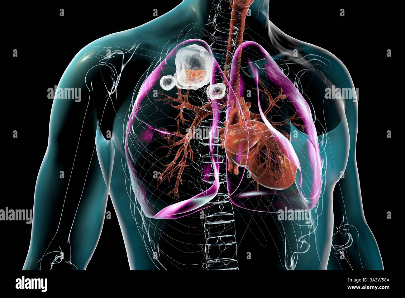 Illustration de tuberculose cavitaire dans le lobe supérieur du poumon droit, organe, organes, montrant des lésions pulmonaires et des cavités. Banque D'Images