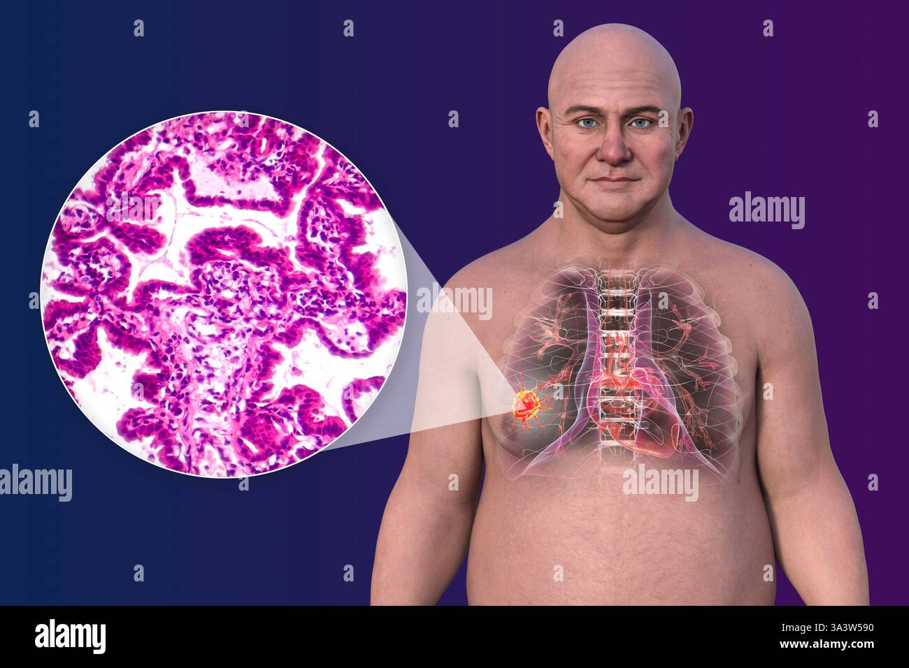 Illustration d'un homme atteint d'un cancer du poumon, montrant la localisation et l'anatomie macroscopique de la tumeur et une micrographie du carcinome épidermoïde. Banque D'Images