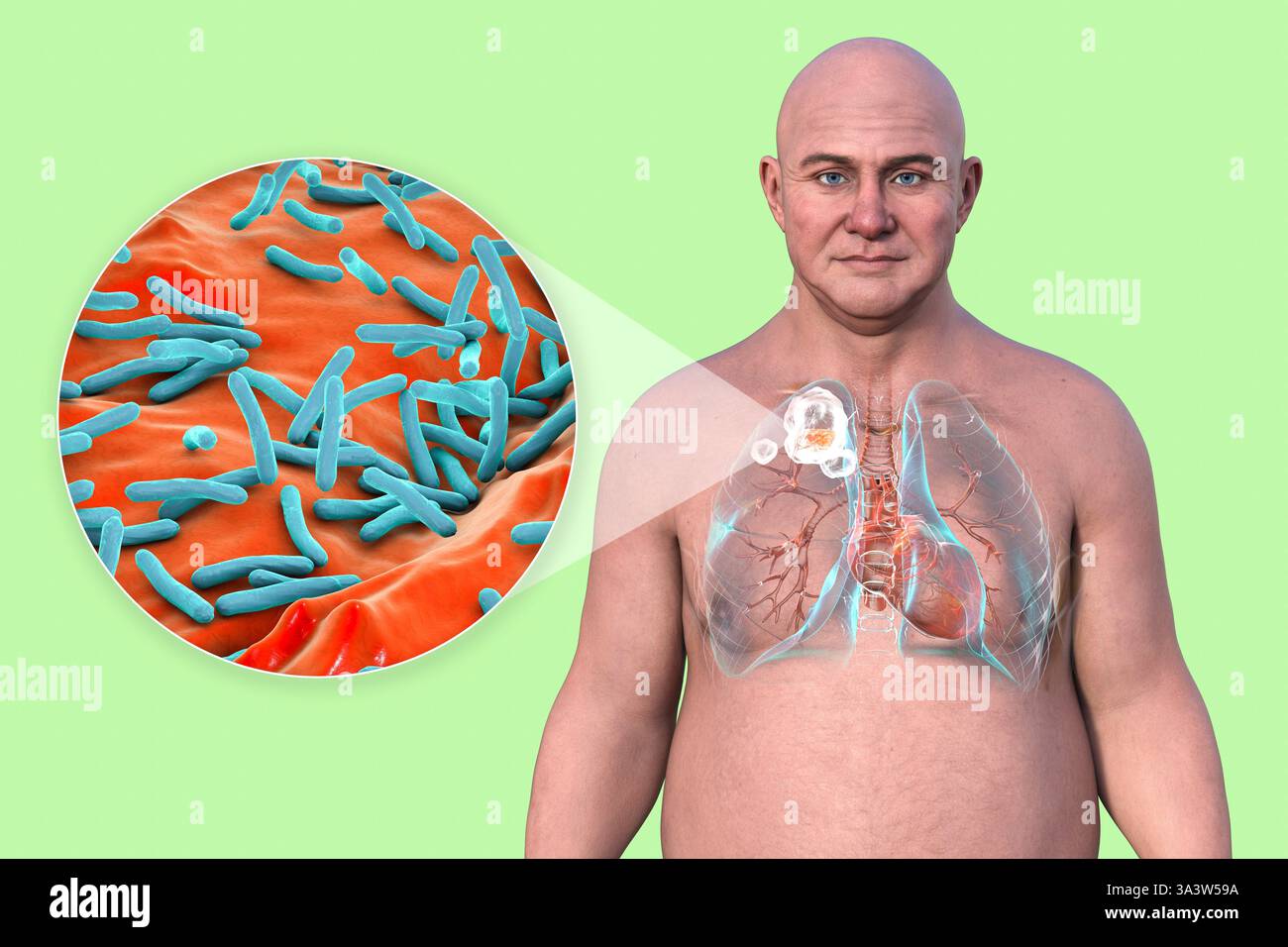Illustration d'un homme avec des poumons atteints de tuberculose cavitaire dans le lobe supérieur droit, montrant des lésions pulmonaires et des cavités, ainsi qu'une vue rapprochée de la bactérie Mycobacterium tuberculosis. Banque D'Images